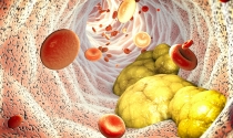 Blutgefäß mit atherosklerotischer Plaque
